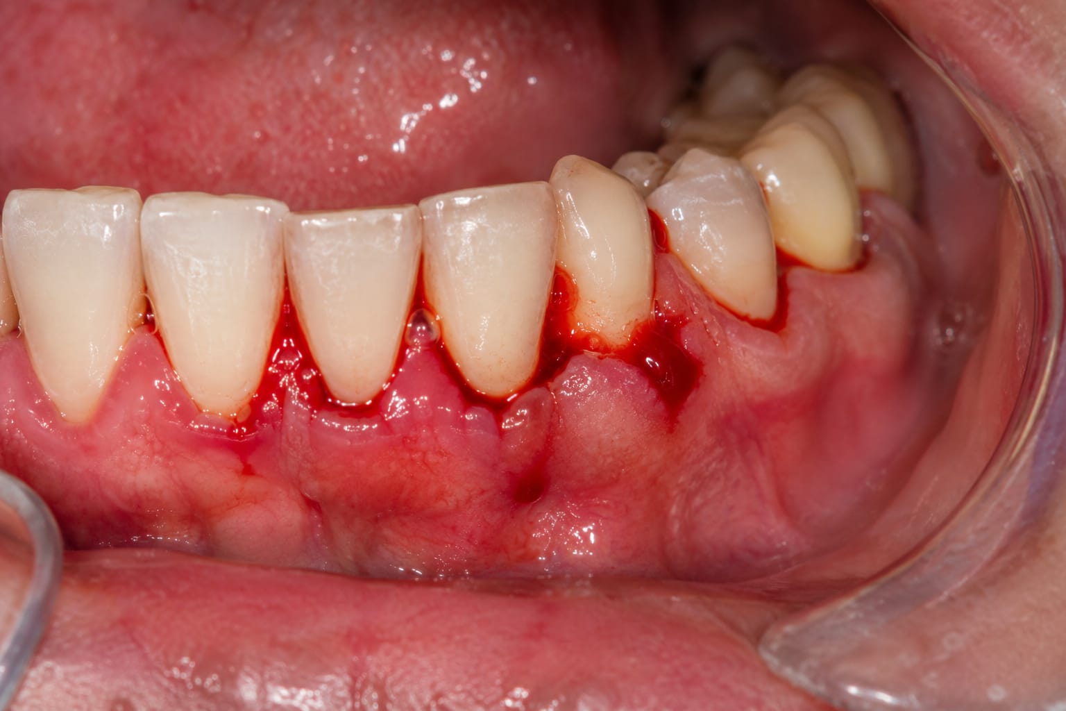 Bleeding Gums